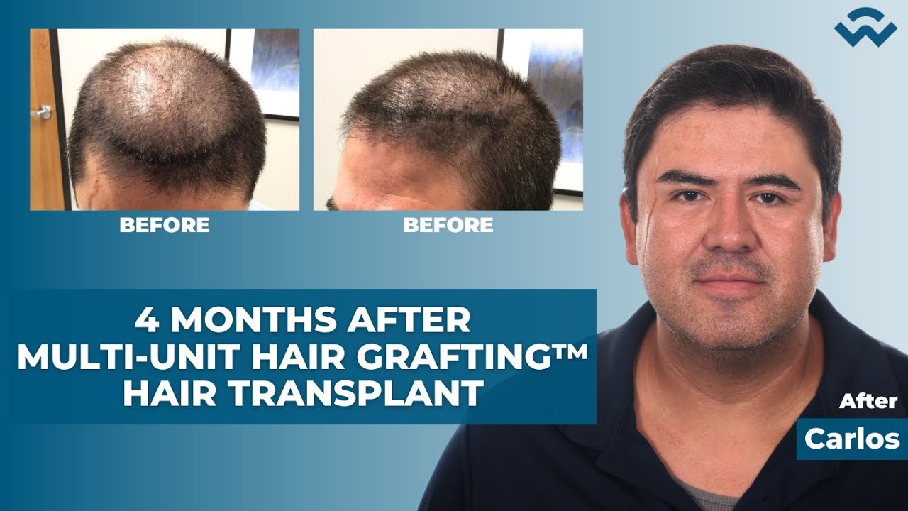 4 Month Follow-Up After Multi-Unit Hair Grafting™ Hair Transplant – Carlos Rincon