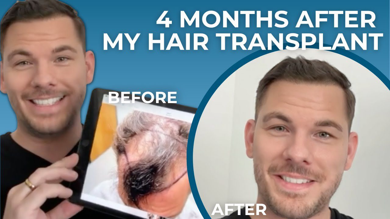 Tyler Parson 4 Months After Multi-Unit Hair Grafting™ Hair Transplant At We Grow Hair Indy