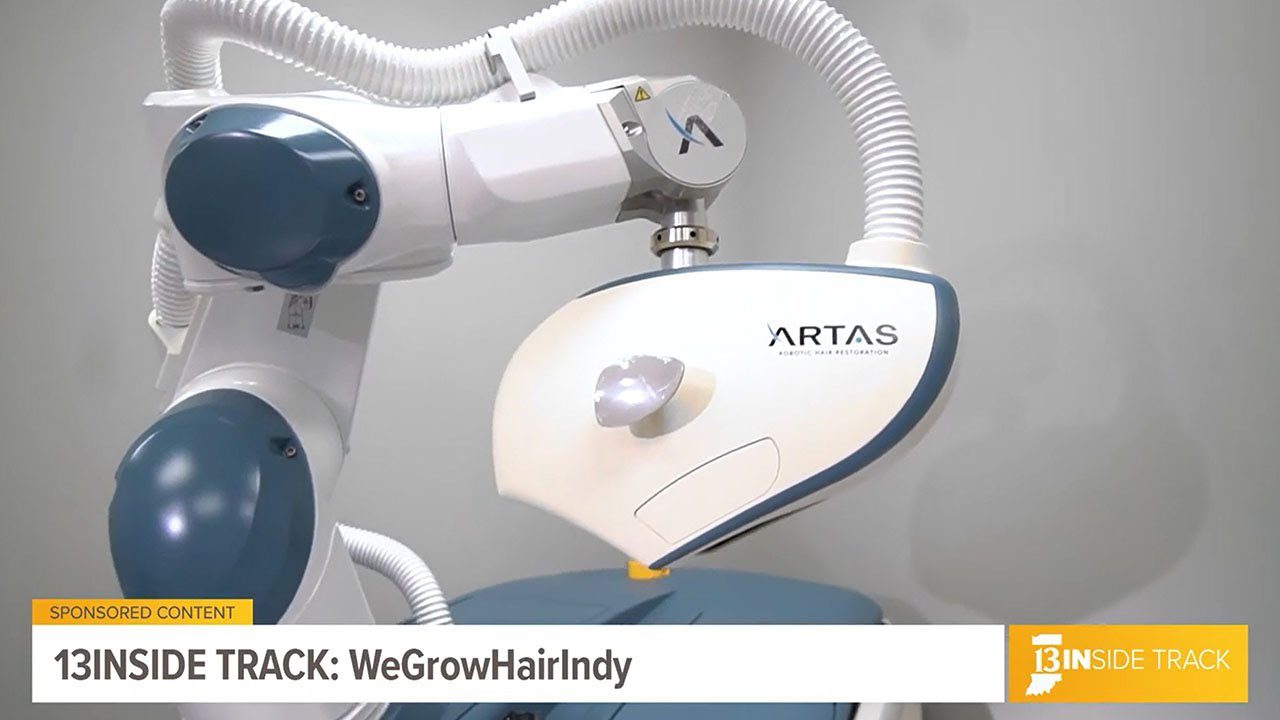 We Grow Hair Indy on 13InsideTrack I ARTAS Robotic FUE Hair Transplant & FUT Hair Transplant Clinic