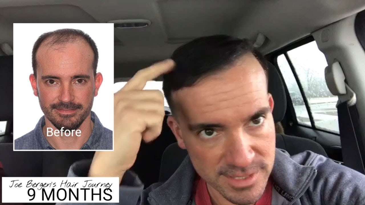Joe Bergen Multi-Unit Hair Grafting™ 12 Month Journey