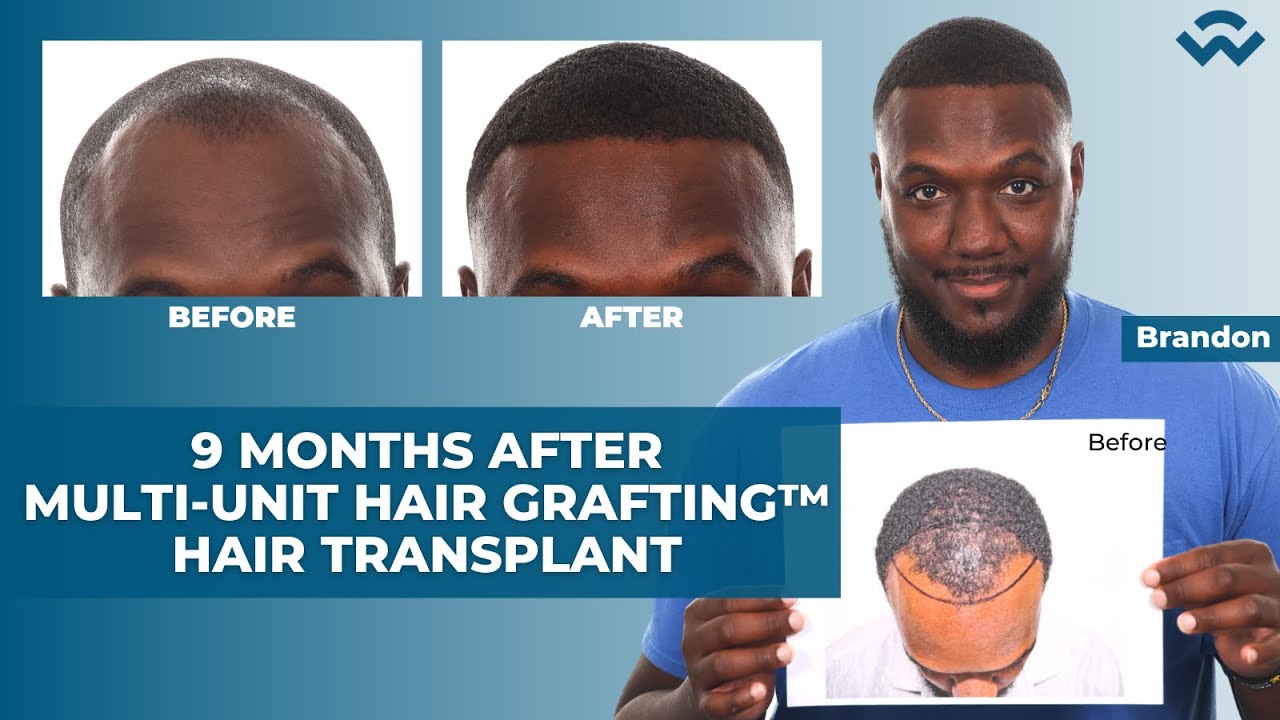 9 Month Results after Multi-Unit Hair Grafting™ Hair Transplant