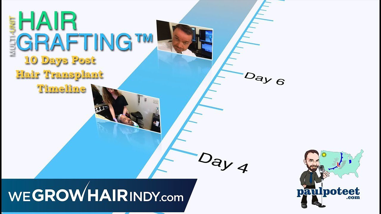 Hair Transplant Recovery First 10 Days – Paul Poteet