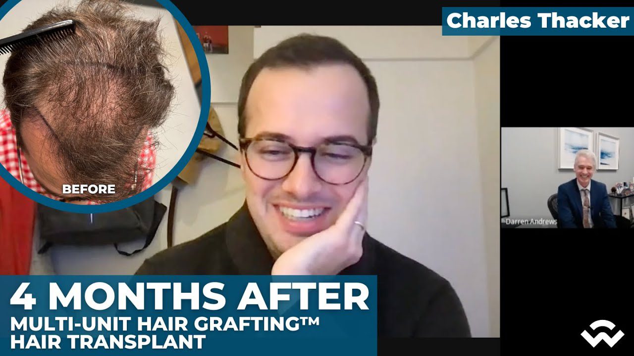 Multi-Unit Hair Grafting™ Hair Transplant – 4 Months After – Virtual Follow-Up
