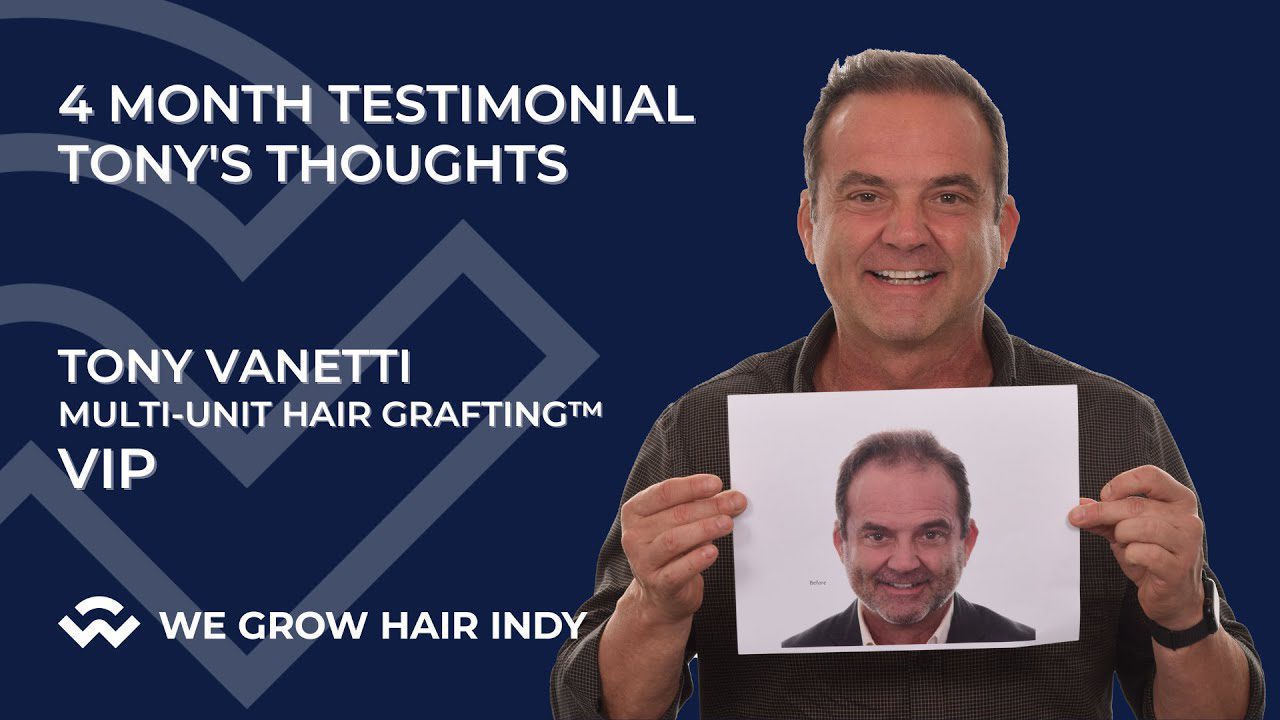 Tony Vanetti’s Thoughts 4 Months After His Hair Transplant