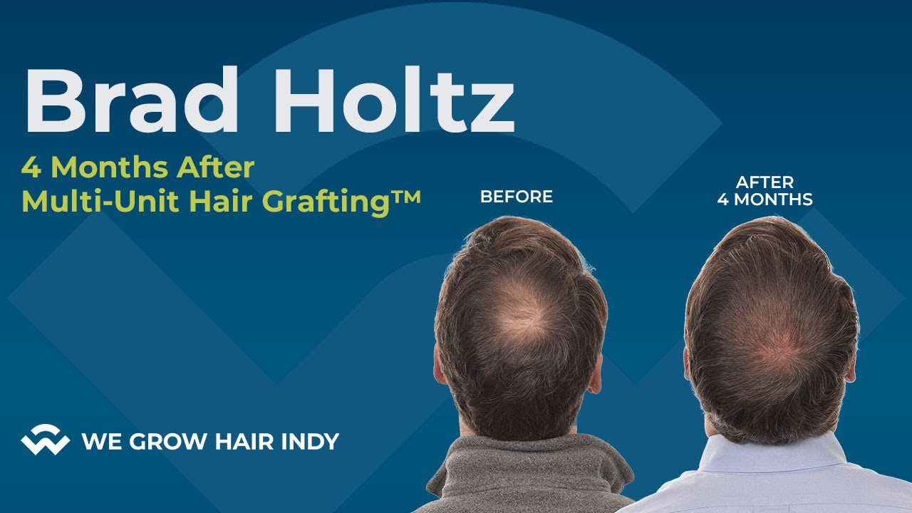 Hair Transplant Recovery Stages I 4 Months After Hair Transplant I Brad Holtz