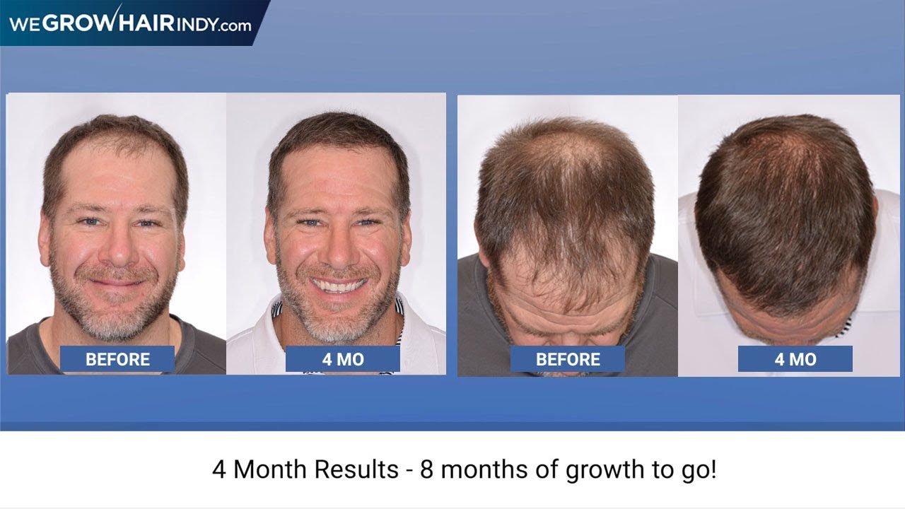 Rick DeMulling 4 Month Multi-Unit Hair Grafting™ Hair Transplant Update
