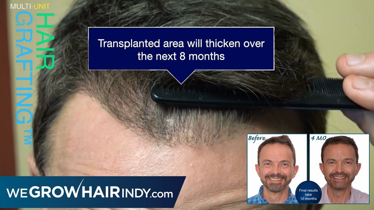 Hairline Hair Transplant Explained [4 Months Post] | Paul Poteet Mister Weatherman