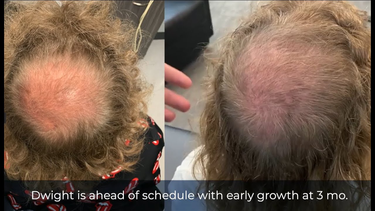 Dwight Witten Check In | 3 Months After a Multi-Unit Hair Grafting™ Hair Transplant
