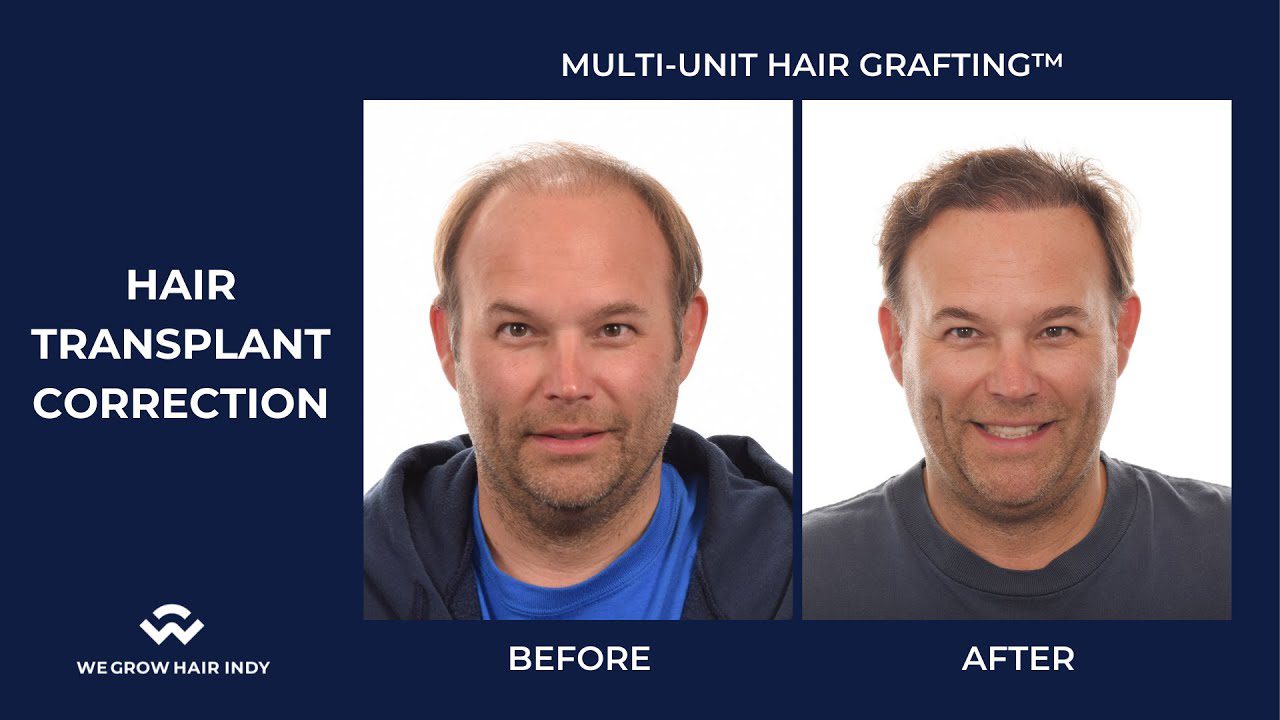 Hair Transplant Correction – Steve’s 12 Month Results