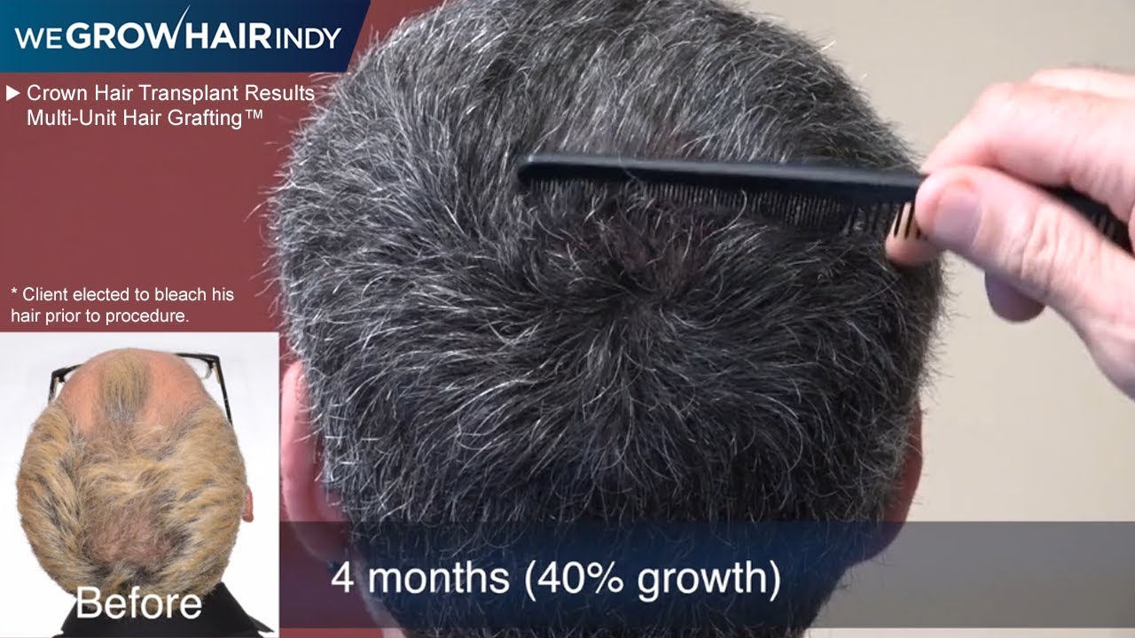 Crown Hair Loss? 4 Month Results