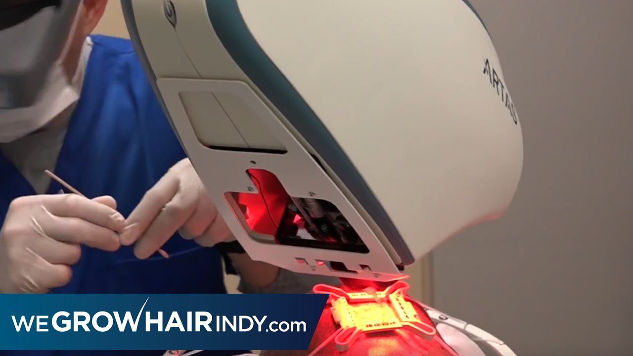 Crown ARTAS Robotic FUE Hair Transplant Procedure