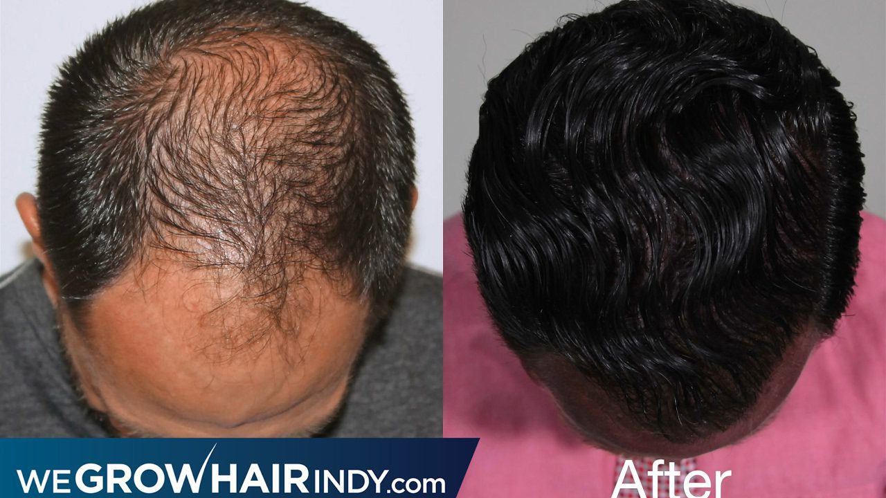 Max Density with One Hair Transplant – Will Testimonial