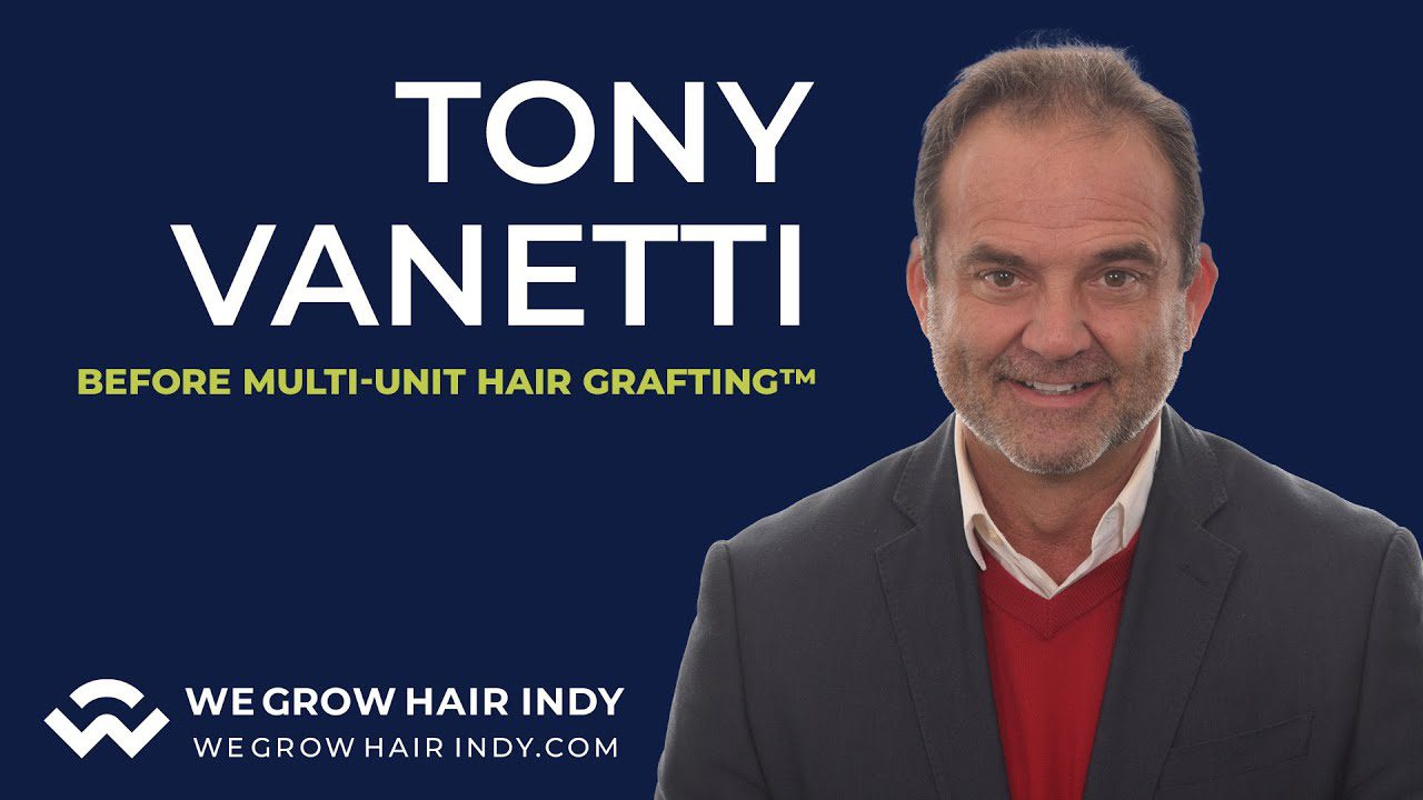 Tony Vanetti Gets a Hair Transplant