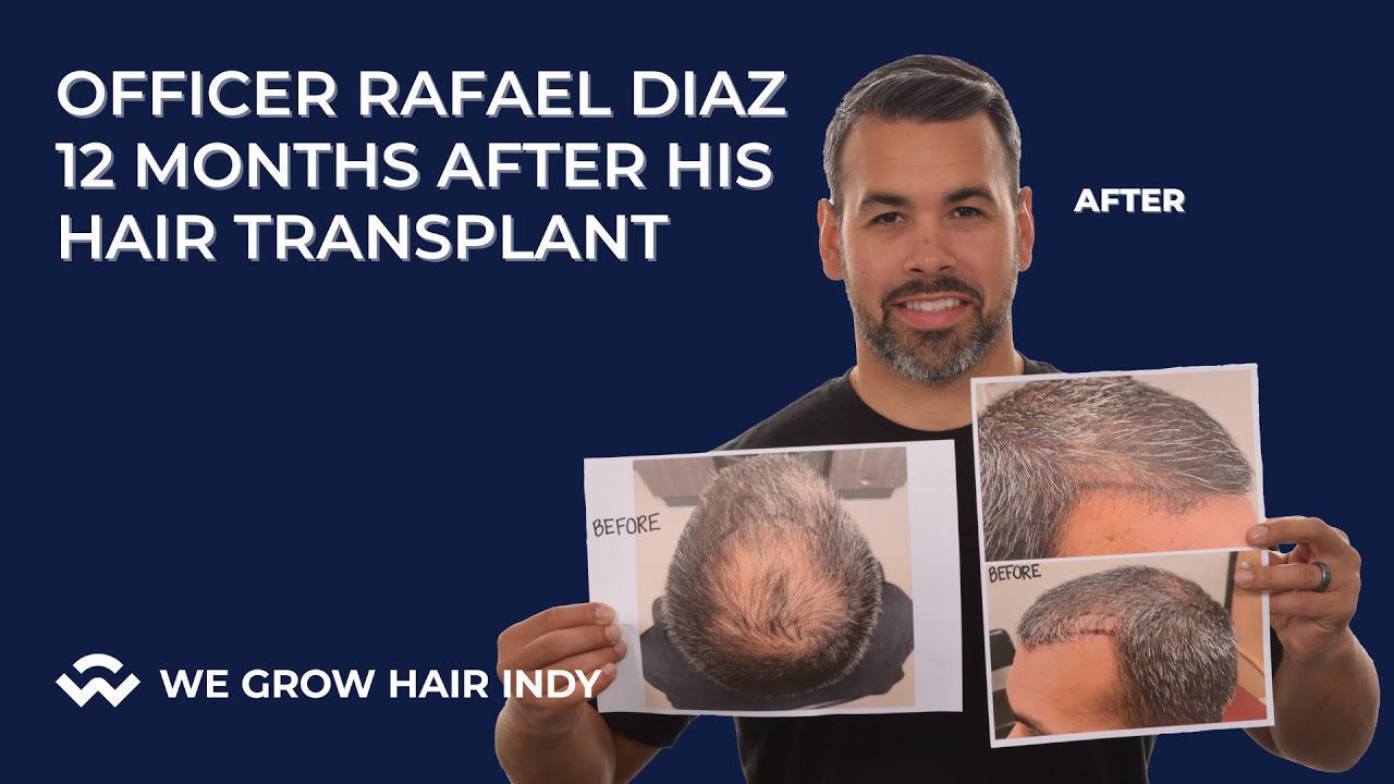Officer Diaz 12 Months After Multi-Unit Hair Grafting™