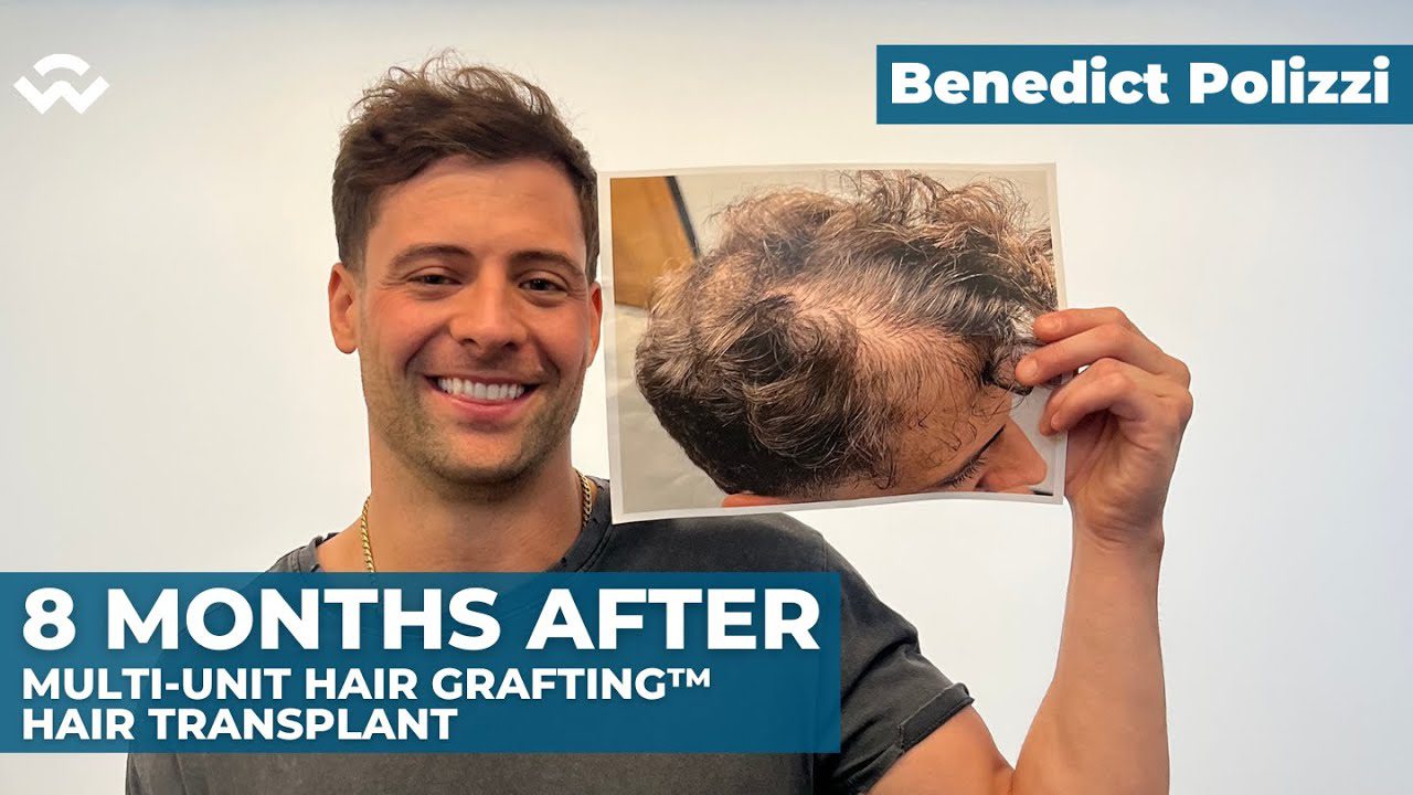 Benedict Polizzi – 8 Months After Multi-Unit Hair Grafting™ Hair Transplant