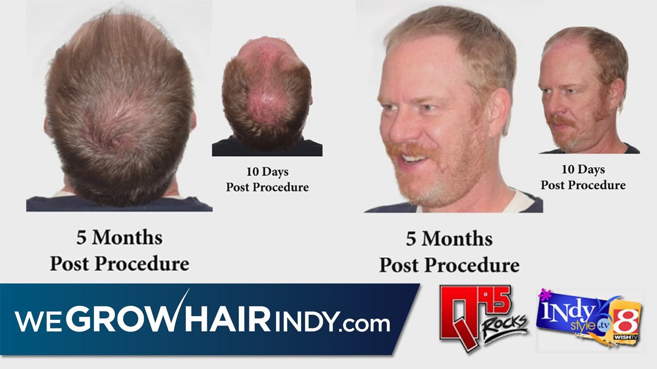 5 Mo. Hair Transplant Results – Q95’s Host Gunner on IndyStyle