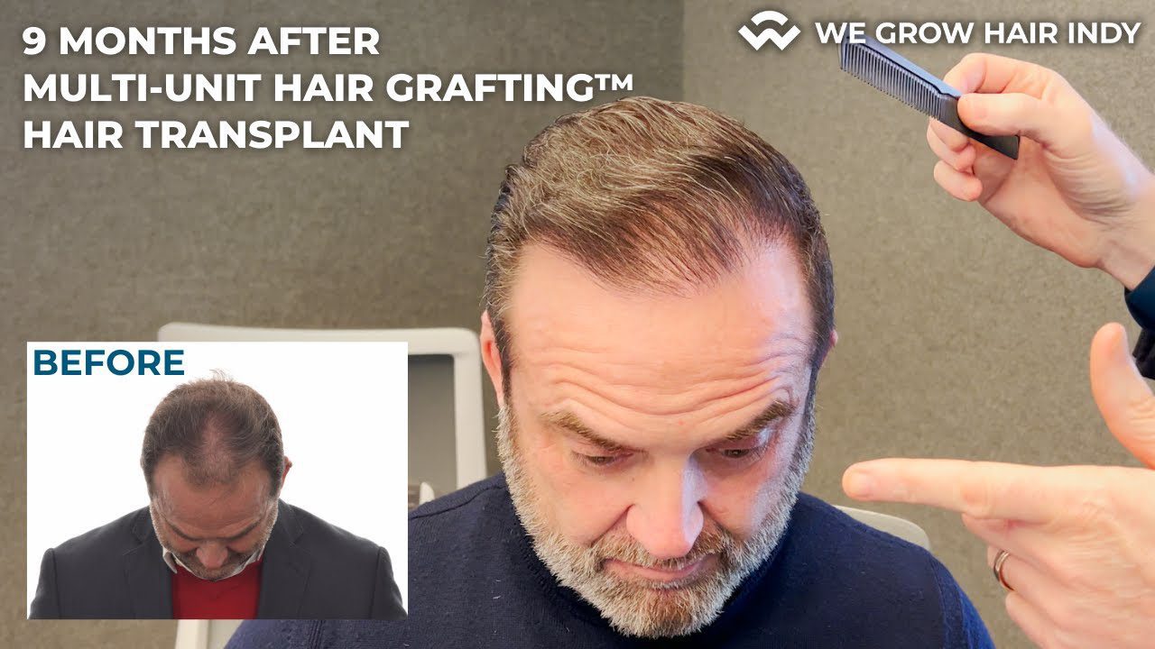 Tony Vanetti 9 Months After His Multi-Unit Hair Grafting™ Hair Transplant!