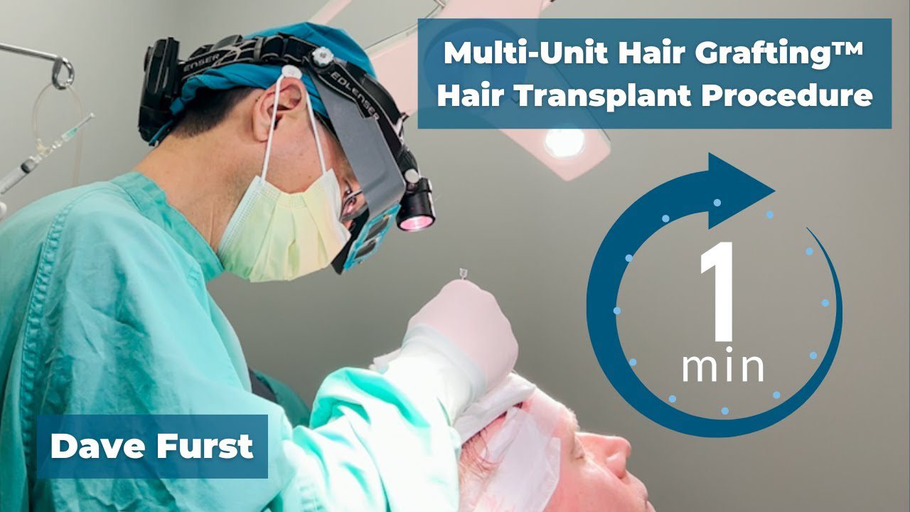 Day of Multi-Unit Hair Grafting™ Hair Transplant in 1 minute! Dave Furst