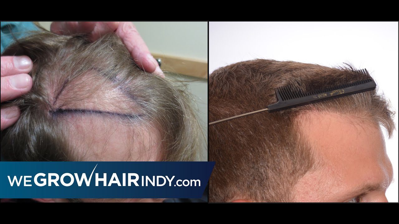 Amazing Hair Transplant Results – Greg