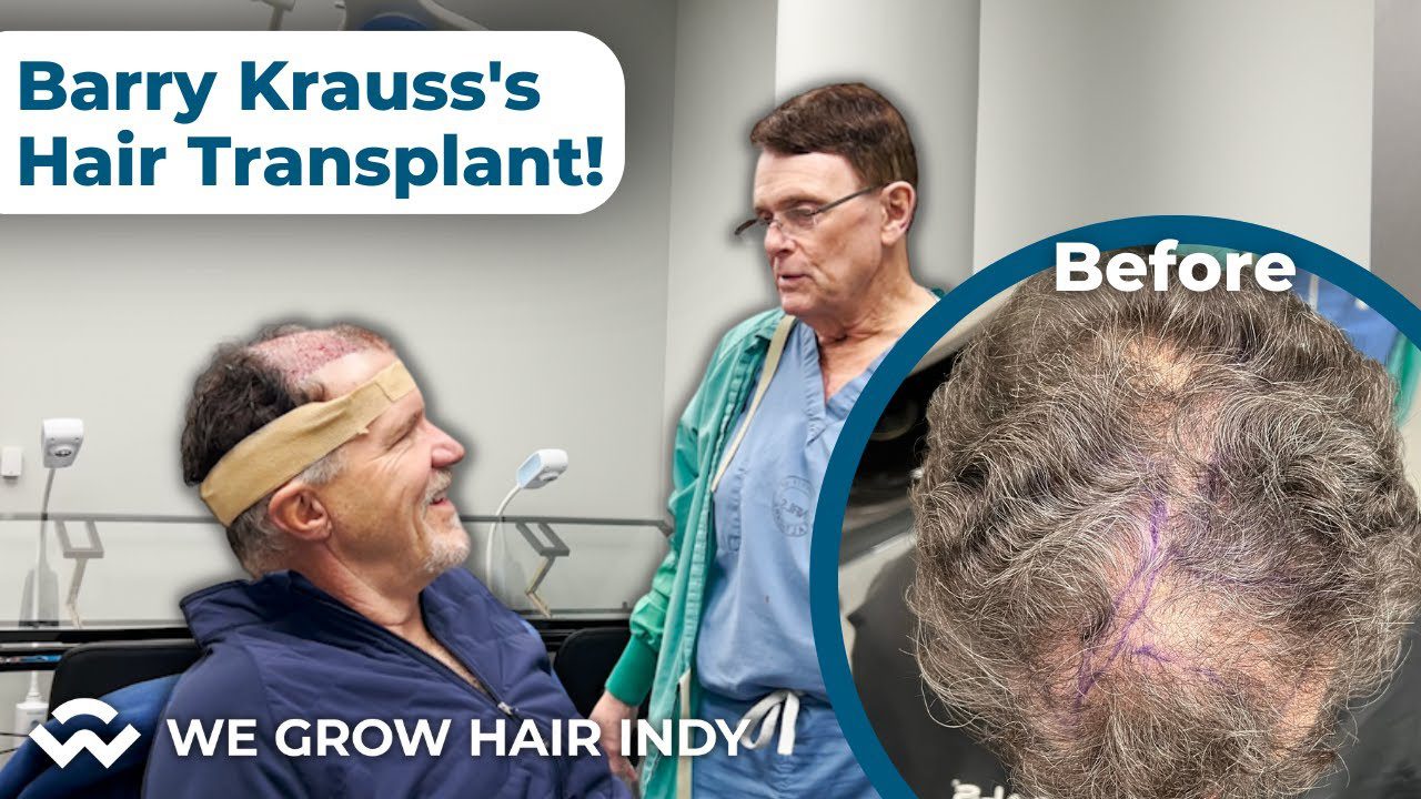 Day of Barry Krauss’s Hair Transplant – Step by Step Multi-Unit Hair Grafting™