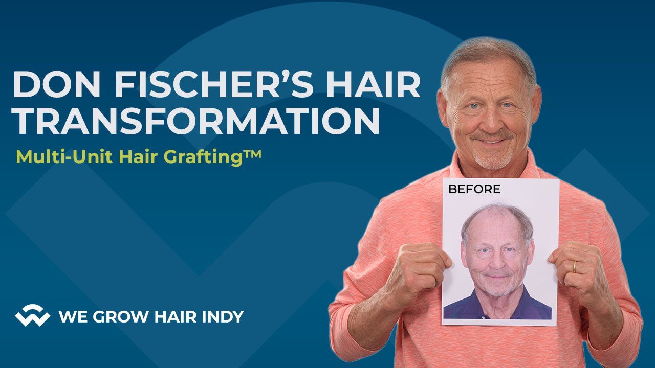 Don Fischer’s Hair Transplant Before and After I WGHI VIP I Don Fischer