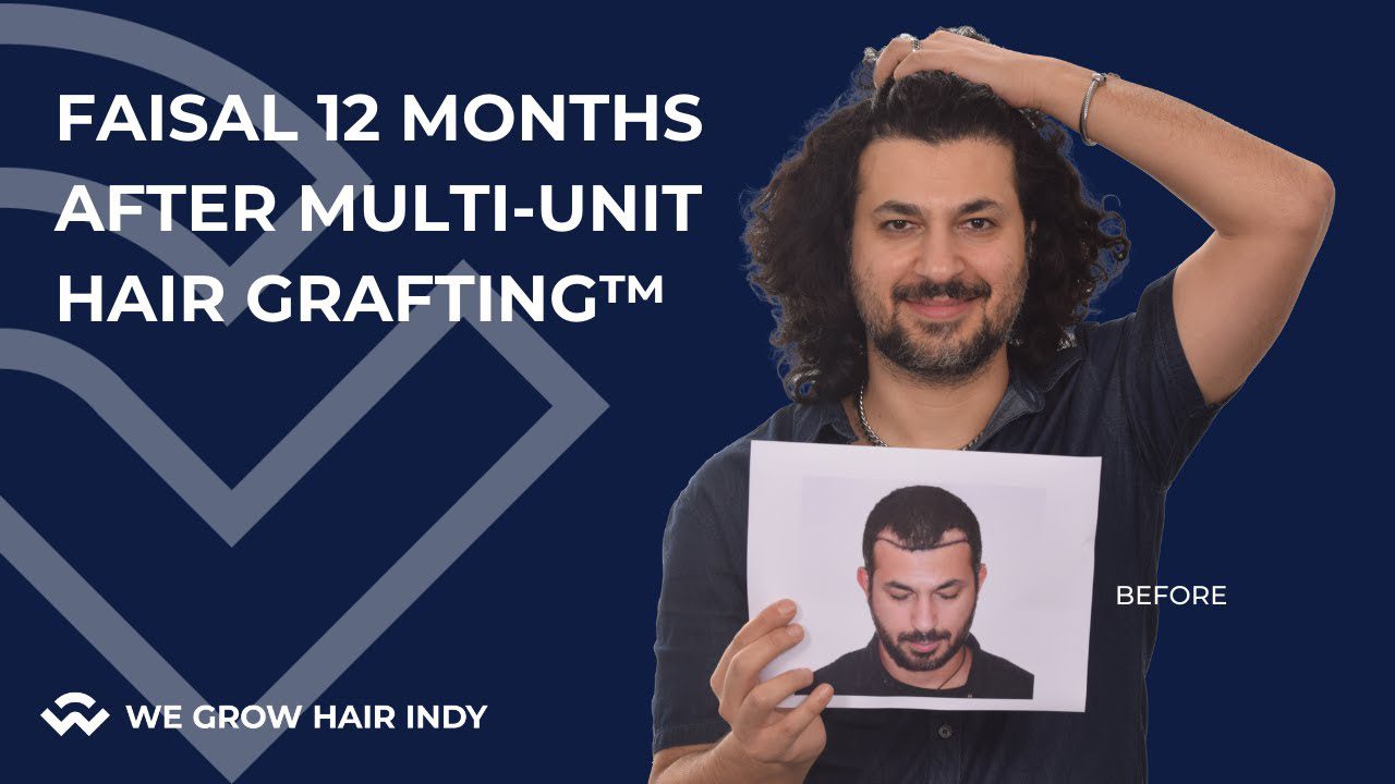 Faisal 12 Month Hair Transplant Results