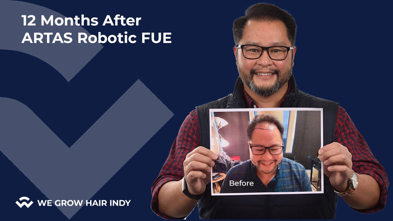 Hair Transplant Recovery Stages I 12 Months After ARTAS Robotic FUE Hair Transplant I Justin