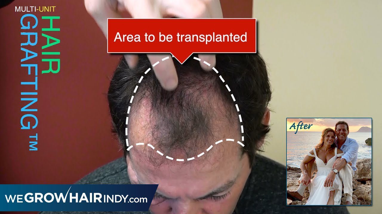 Hair Transplant Results | Great Hair for a Special Day