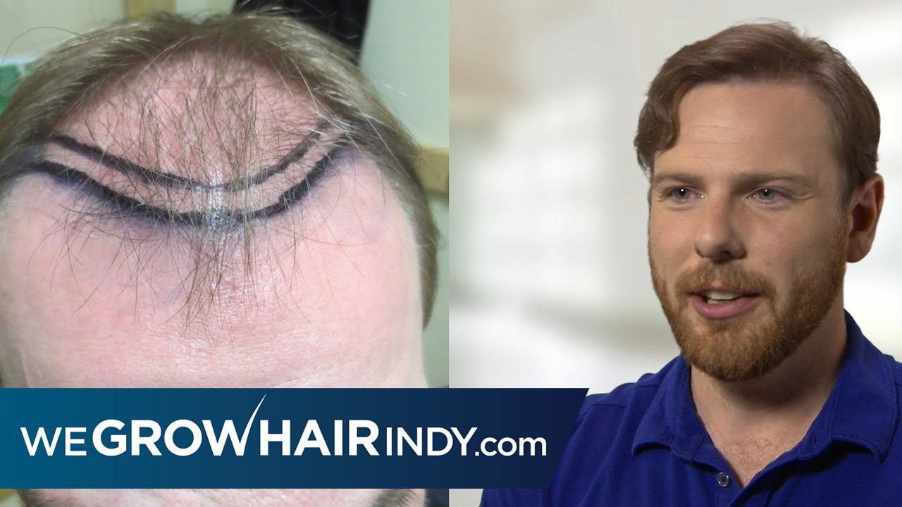 Multi-Unit Hair Grafting™ Hair Transplant – Sean