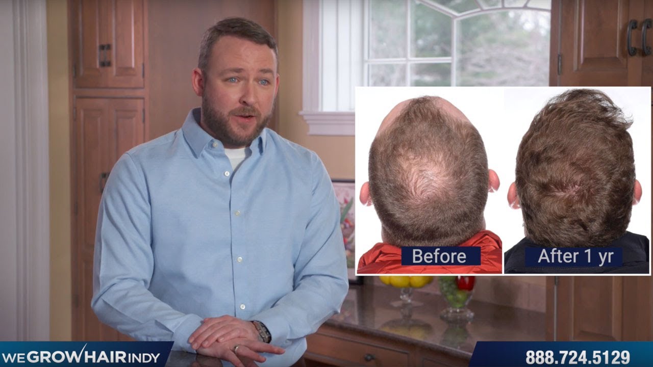 Crown & Hairline Transplant – We Grow Hair Indy Patient Bobby