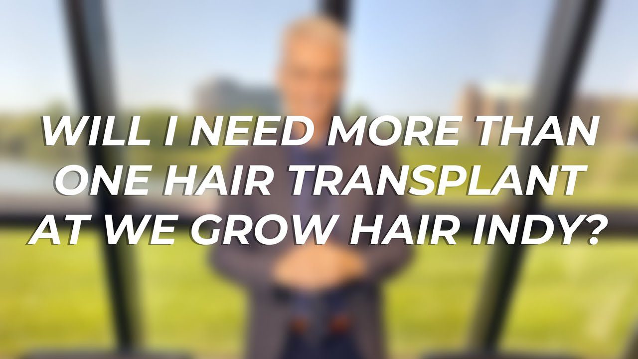 Will I Need More Than One Hair Transplant?