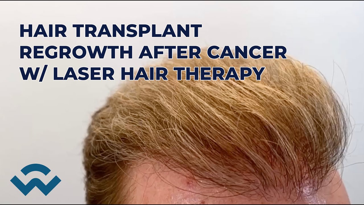 Lee’s Story – Hair Transplant Regrowth After Cancer With Laser Hair Therapy