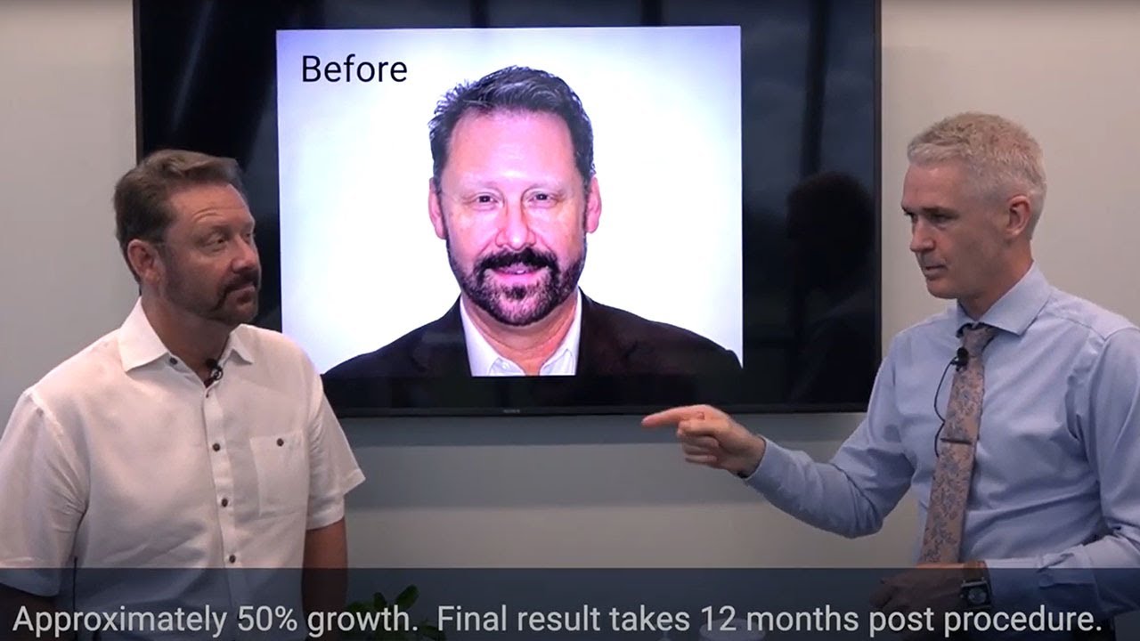 Hair Transplant Results at 4 Months – Jeff Brummett