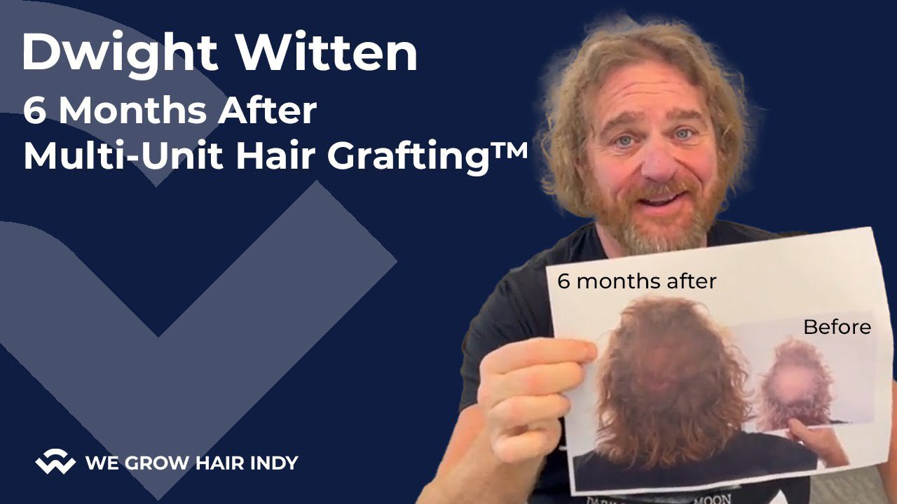 Dwight Witten Check In | 6 Months After a Multi-Unit Hair Grafting™ Hair Transplant