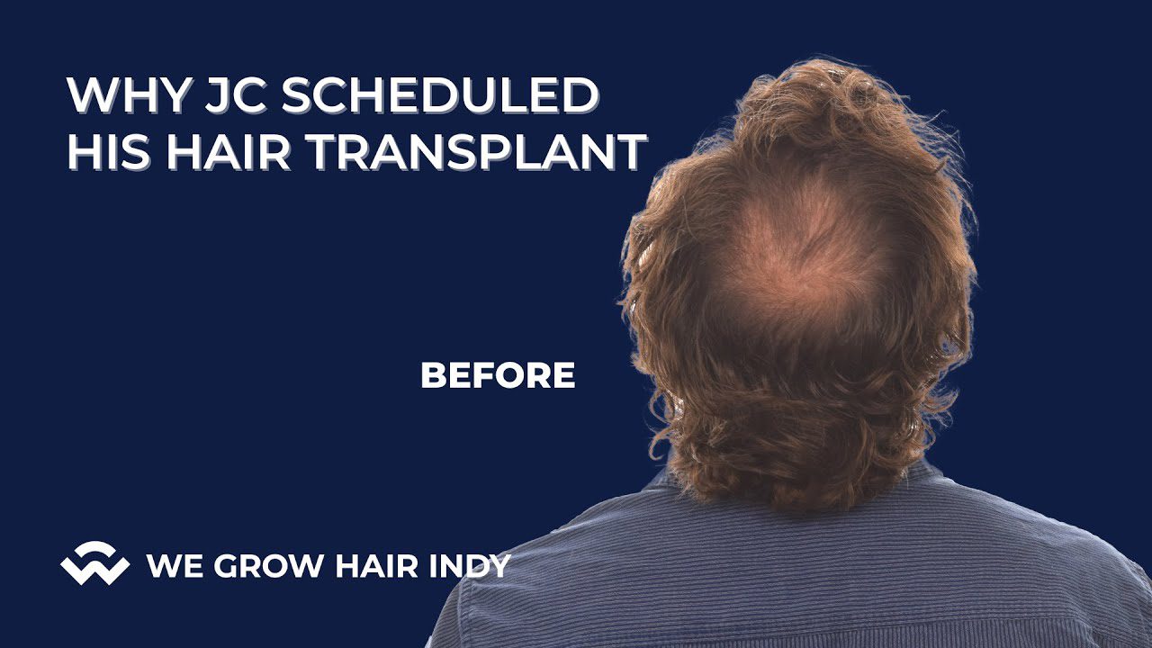 Why JC Scheduled His Hair Transplant