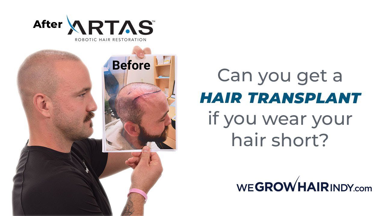 9 months after ARTAS Robotic FUE hair transplant I Client Results I Kyler