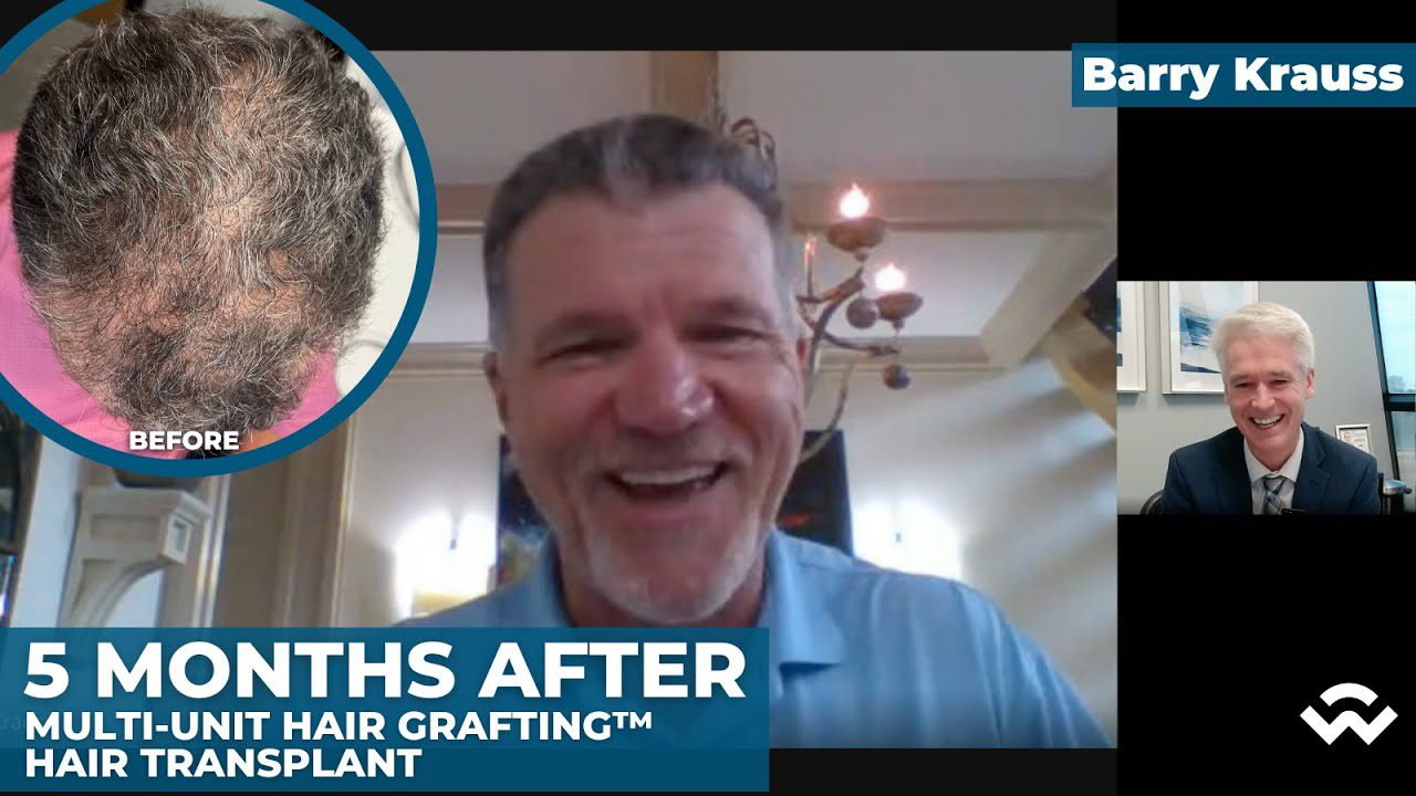 1# Draft Pick Barry Krauss – Multi-Unit Hair Grafting™ Hair Transplant after 5 Months
