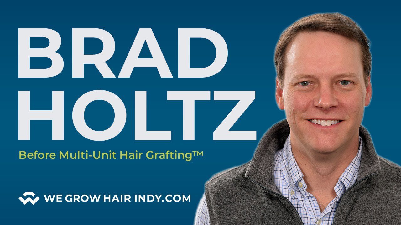 Why Brad Holtz from 92.3 WTTS is Getting a Hair Transplant I WGHI VIP I Brad Holtz