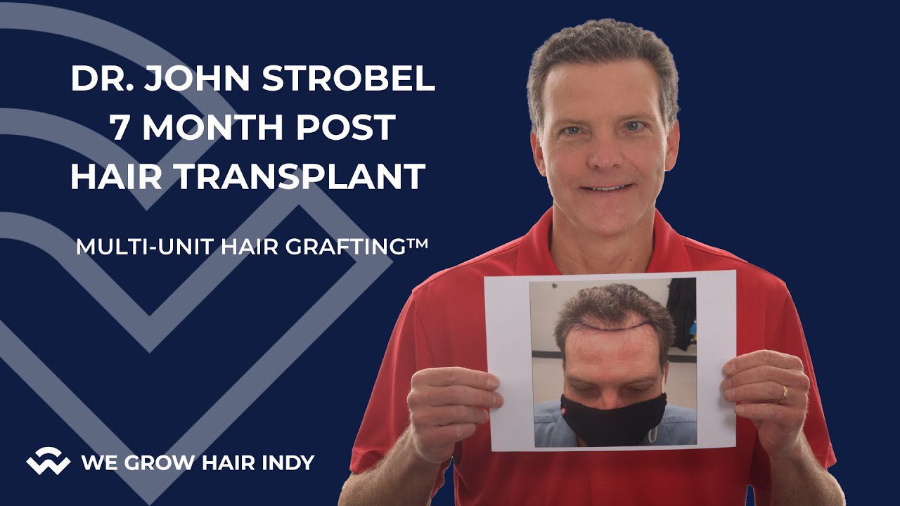 Hair Transplant 7 Months Later – We Grow Hair Indy – Dr. John Strobel