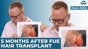 5 Months after ARTAS Robotic FUE Hair Transplant - Shawn Bailey