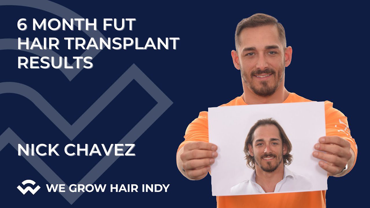 Hair Transplant Results After 6 Months | Before & After l Nick Chavez