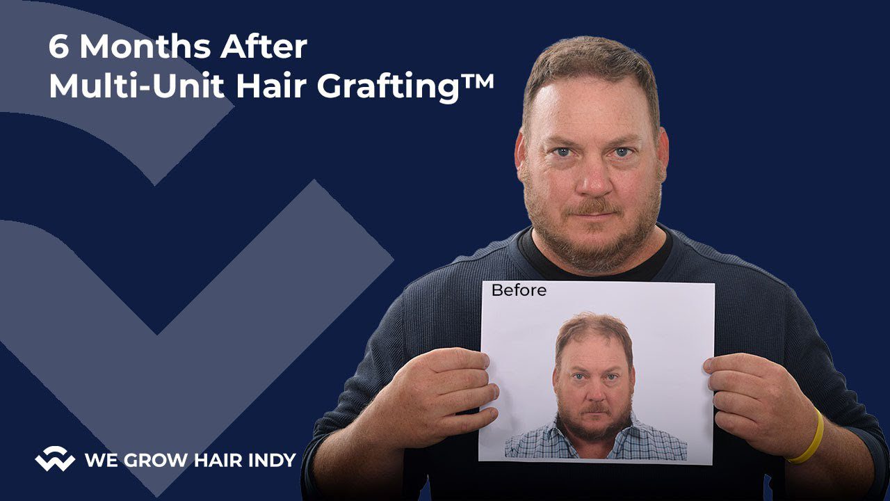 Hair Transplant Recovery Stages I 6 Months After Hair Transplant I Justin