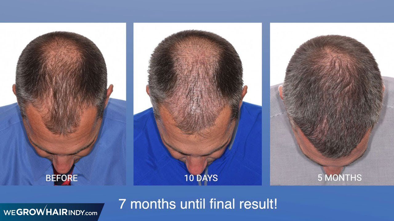 Basketball Coach Hair Transplant – Multi-Unit Hair Grafting™