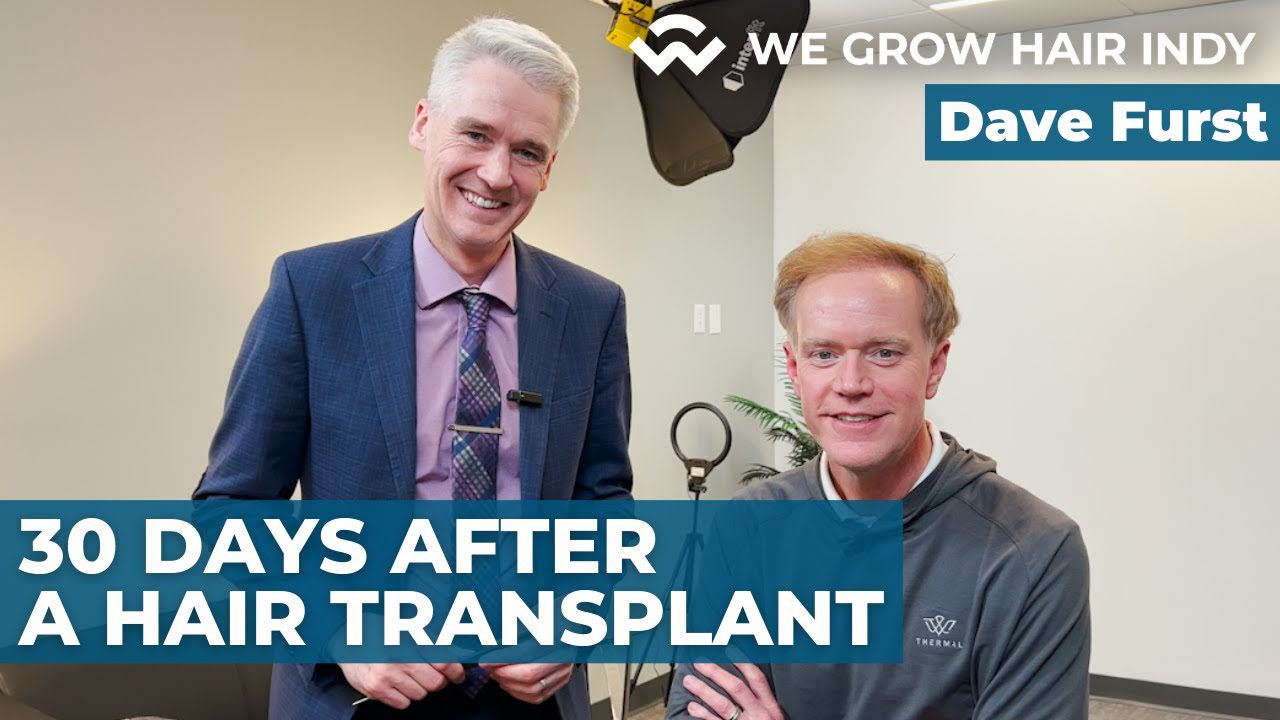 Multi-Unit Hair Grafting™ Hair Transplant – 30 Days After Dave Furst’s Procedure