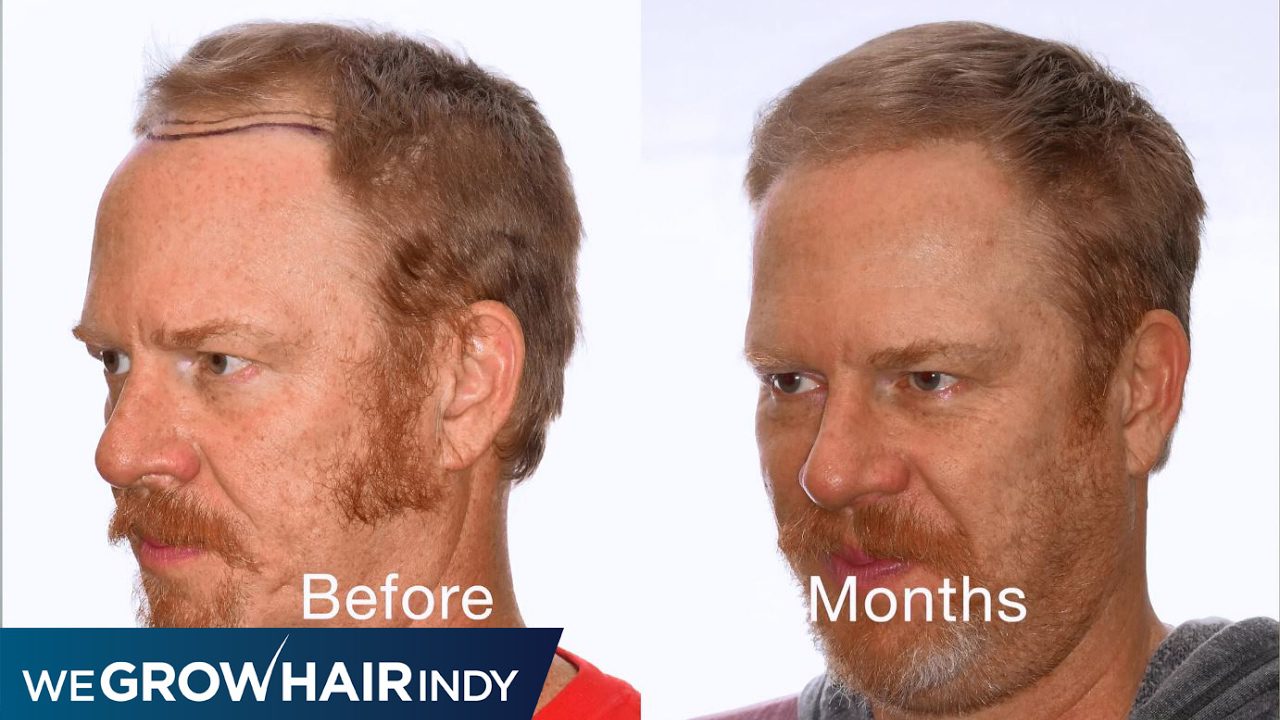 5 Month after Hair Transplant | Gunner from Q95
