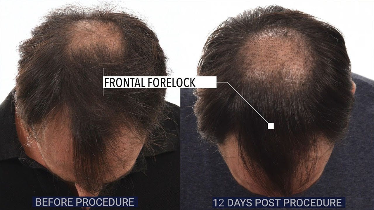 Hair Transplant Recovery Stages I 12 Days After Hair Transplant Results I Alex Fortey