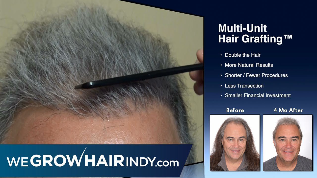 What does a post hair transplant progression look like? – 97.5FM Don Stuck
