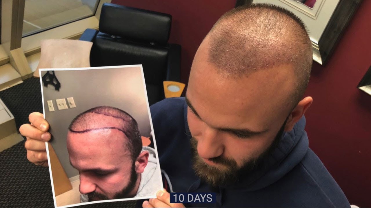FUE Robotic Hair Transplant – 10 Days After