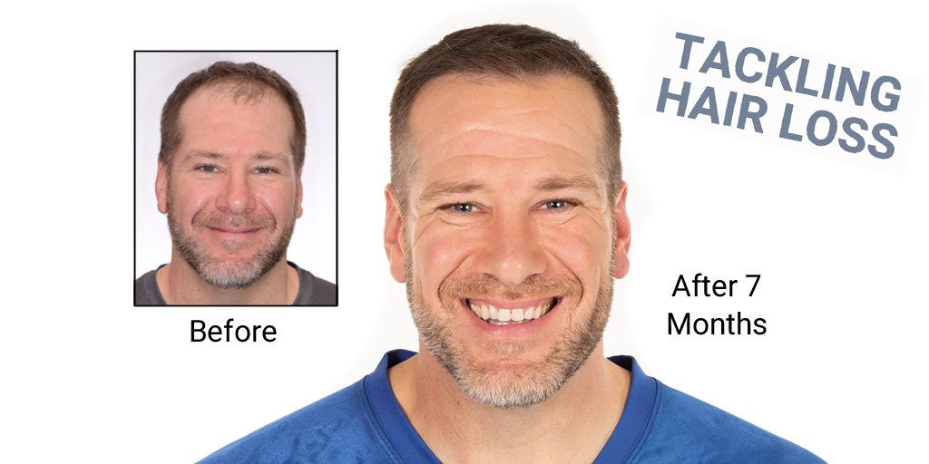 8 Month Hair Transplant Update - Rick DeMulling, Former Professional Football Player