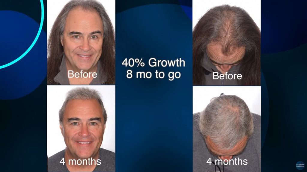 97.5 FM Don Stuck’s Amazing Hair Transplant 4 Month Results